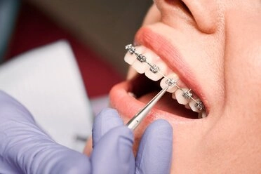 braces installments work