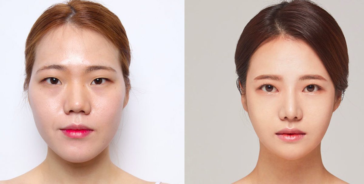 South Korea’s Best Plastic Surgery